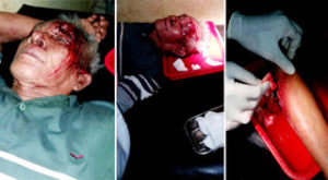 Lubang Karya URC Mulai Makan Korban, Warga Karang Anyar Derita Luka Serius