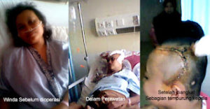 Dukungan Terhadap Winda Lestari Terus Mengalir