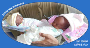 Miris, Salah Satu Dari Bayi Kembar Ini Derita Jantung Bocor