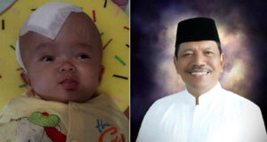 Penderita Hidrosefalus Dapat Perhatian Bupati BU