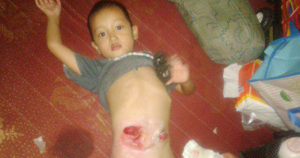 Tiga Tahun Derita Hischprung, Balita Taba Tembilang Ini Butuh Bantuan